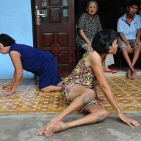 L'agent orange, rsponsable de handicaps
